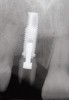 Fig 8. The abutment seated on the implant.