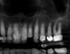 Fig 2. Preoperative CBCT-reconstructed panoramic radiograph with fiducial marker.