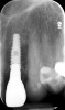 Fig 10. Periapical radiograph at 14 months restored.