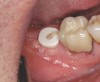 Fig 18. Healing at 4.5 months, occlusal view.