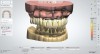 Fig 14. Digital scans were exported from the scanner and imported into dental laboratory software. An open-palate maxillary framework was designed, and virtual teeth were placed onto the scan. A tissue-surface design file was created, fitting the designed framework in the intaglio surface and pockets prepared for commercially available denture teeth.