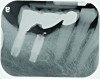 A fractured implant is classified as an intermediate complication