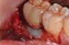 A hydrogel barrier was used over the composite graft for its containment.