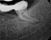 Fig 11. Case 2: Significant bone loss on the mesial and apical aspect suggested a potential vertical fracture (Fig 9 and Fig 10). Radiographic images were taken immediately postoperatively (Fig 11) and 7 months postoperatively (Fig 12).