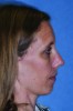 (2.) A patient with the myofascial pain subtype of temporomandibular disorder presenting with an adenoid facial type, high mandibular angle, and retrognathic mandible.