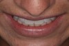 (5.) Tip-down smile photo. The maxillary incisal edge should land on, or point towards, the vermilion border (wet/dry line) of the lower lip.
