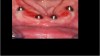 Fig 12. Keratinized gingiva 4 months postoperatively.