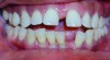 Figure 3 “Before” photograph of an adult patient with significant periodontal disease and recession with some teeth that historically might have been considered “hopeless.”