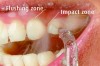 Figure 7 The impact zone is where the pulsating wa-ter from a water flosser initially hits the tooth at the gingival margin, and the flushing zone is the penetration into the sulcus or pocket.