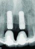 Fig 3. Radiograph confirming that the implant placement matched the presurgical plan.