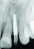 Fig 9. Radiograph taken at the time of implant placement confirming that the implant is precisely positioned, matching the presurgical plan.