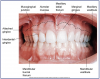 Figure 5 – Labial Mucosa (Courtesy of Modern Dental Assisting, 10th Edition, Bird et al, Figure 10:6). Photograph of facial mucosa.