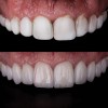 (5.) Comparison of line angles between patient’s previous composite veneers and new porcelain veneers.