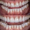 (8.) Before and after photographs with almost identical widths in the incisal one-third, but the added height to the teeth in the postoperative photograph makes them appear narrower.