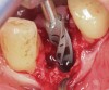 Fig 5. Osteotomy into the extraction socket under robotic guidance.