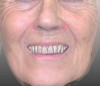 Fig 11. The face-scan is superimposed on the model at rest (Fig 10) and smiling (Fig 11). The gingival tissue is displayed at rest. This type of case will require ridge reduction if the treatment plan is directed toward an all-on-4 or -6 proposal.
