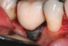 Fig 2. The height of this abutment was less than 2 mm on the facial. This may have led to additional marginal bone loss. Bacterial colonization of the abutment and the exposed implant body resulted in peri-implantitis.