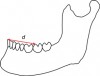 Fig 6. Schematic illustration describes “d” as a fraction of the distance from the incisal point to the cusp in question.