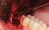 Fig 3. Extraction socket after removal of the impacted mandibular third molar.