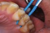 Fig 7. An example of the use of thicker picks for premolar interproximal sites.