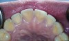 Figure 5. Exposed dentin can exhibit dentin hypersensitivity. Figure 4 is an example of enamel loss with exposed dentin caused by tooth attrition. Figure 5 is an example of enamel loss with exposed dentin caused by bulimia. The treatment in both cases was full-coverage crowns.