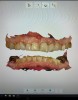 Fig 1. A digital intraoral scan recording the full dentition pictorially.