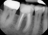 Fig 3. A traditional periapical radiograph of a symptomatic endodon-
tically treated first molar.