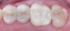 Fig 12. The new single-unit restoration was milled in-office from full zirconia and delivered to the patient within a single appointment. The fit was excellent, and the patient and clinician were both pleased with the final outcome.