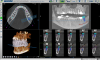 Fig 4. Dynamic guided implant treatment-planning panoramic with intraoral scan imported, allowing treatment planning with occlusion between arches.