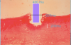 Fig 1. Photomicrograph of near-infrared laser incision. A 400-μm fiber will vaporize epithelium 600 μm wide and coagulate to an average depth of 200 μm when no thermal damage is visible macroscopically (courtesy of the Academy of Laser Dentistry).