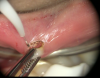 Fig 7 through Fig 9. Fibroma removal, preoperative intraoral (Fig 7) through postoperative (Fig 9) photographs.