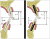 Fig 1. Comparison between the natural dentition assembly and the dental implant–tooth restoration assembly.