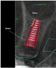 Fig 2. CBCT image and virtual
implant placement identifying 2 mm of bone surrounding the entire implant, centered within the maxillary alveolus.