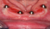 Fig 12. Keratinized gingiva 4 months postoperatively.