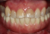 Fig 13. Final screw-retained zirconia restoration.