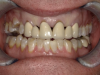 Fig 4. Preoperative photograph of patient with fixed partial dentures (FPDs) Nos. 6 through 8 and 9 through 11. The patient was unhappy with the esthetics over time and wanted the FPDs replaced to be more esthetically appealing.