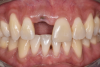 Fig 8. The patient presented after implant placement and appropriate healing on tooth No. 8.