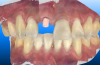 Fig 9. The scan body in place on tooth No. 8 and the final impression in occlusion.