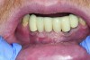 Fig 6. View of implant-supported restoration—the center implant had gingival augmentation prior to the loss of the tooth.