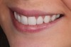 The incisal edge followed the inner vermillion border of the lower lip, anterior to posterior.