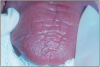 Figure 1 – Dry mouth associated with Sjögren’s syndrome. The tongue is dry and pale and has lost papillation of the surface.