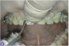 Gingival retraction paste technique