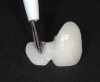 Fig 7. After the bridges were tried in and the intaglio surface of the zirconia wings were sandblasted with 50-µm aluminum oxide at 30 PSI to 40 PSI of air pressure, a 10-MDP dedicated primer was placed and warm-air–dried for 30 seconds.