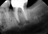 Preoperative periapical radiograph of tooth N o. 18.