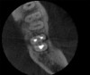 CBCT axial view of tooth
No. 18 revealed canal obturation within normal limits.