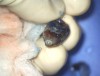 Extracted tooth N o. 18. Under surgical microscope, root-end resection and canal preparation
were performed prior to placement of root-end bioceramic filling.