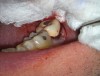 Tooth N o. 18 immediately after replacement in socket prior to suturing.