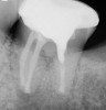 Periapical radiograph of tooth N o. 18 at
2-month recall appointment.