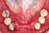 Periodontally involved teeth were treatment
planned for extraction.