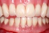 A final maxillary complete denture and interim mandibular complete denture were delivered at the time of extraction of the mandibular
teeth.